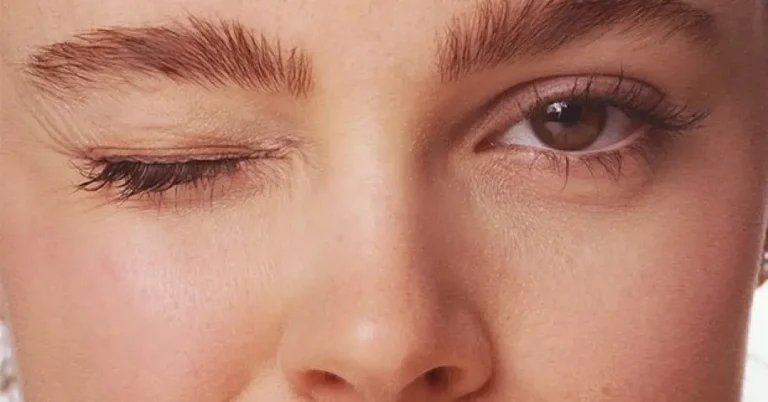 ojeras